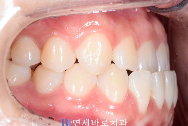 치료 전 ①