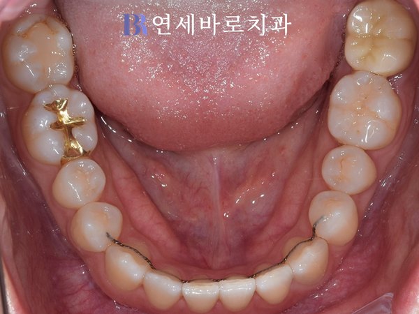 치료 후 ④