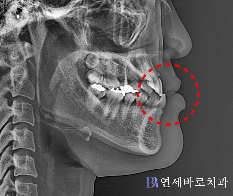 반대교합 치료 전 측모 두부방사선 사진