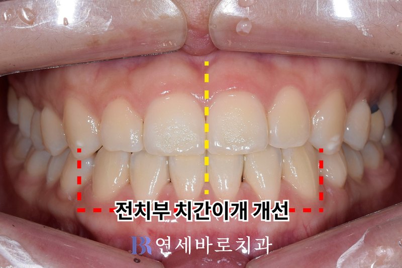 노은동 치과 반대교합 투명교정 치료 후 정면 구내 사진