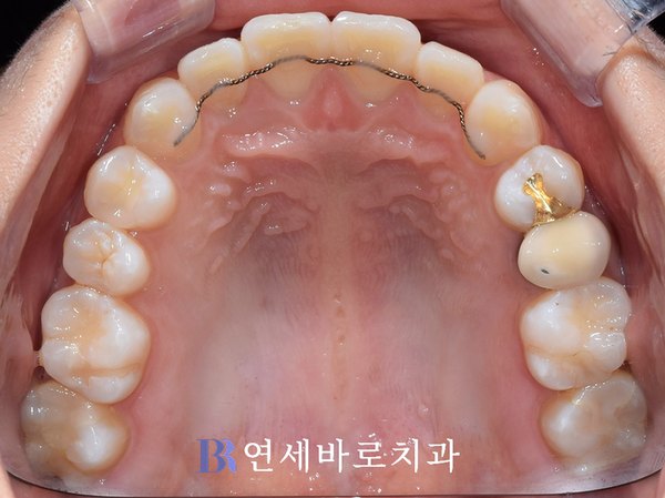 치료 후 ③