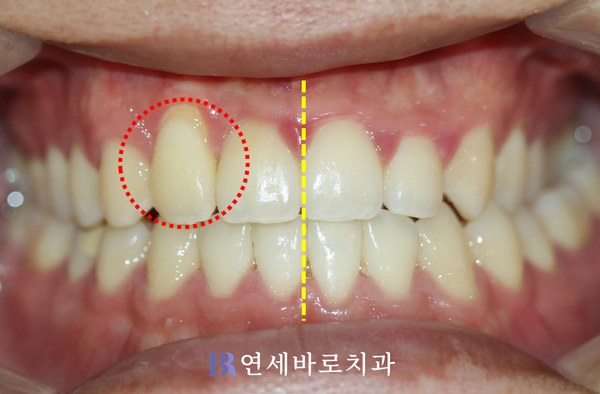 매복치 교정 치료 후 정면 구내 사진