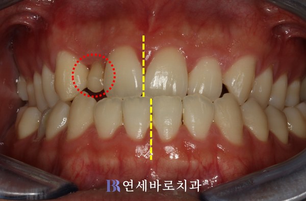 매복치 교정 치료 전 정면 구내 사진
