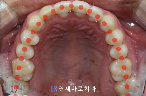 매복치 교정 치료 후 상악 교합면 사진