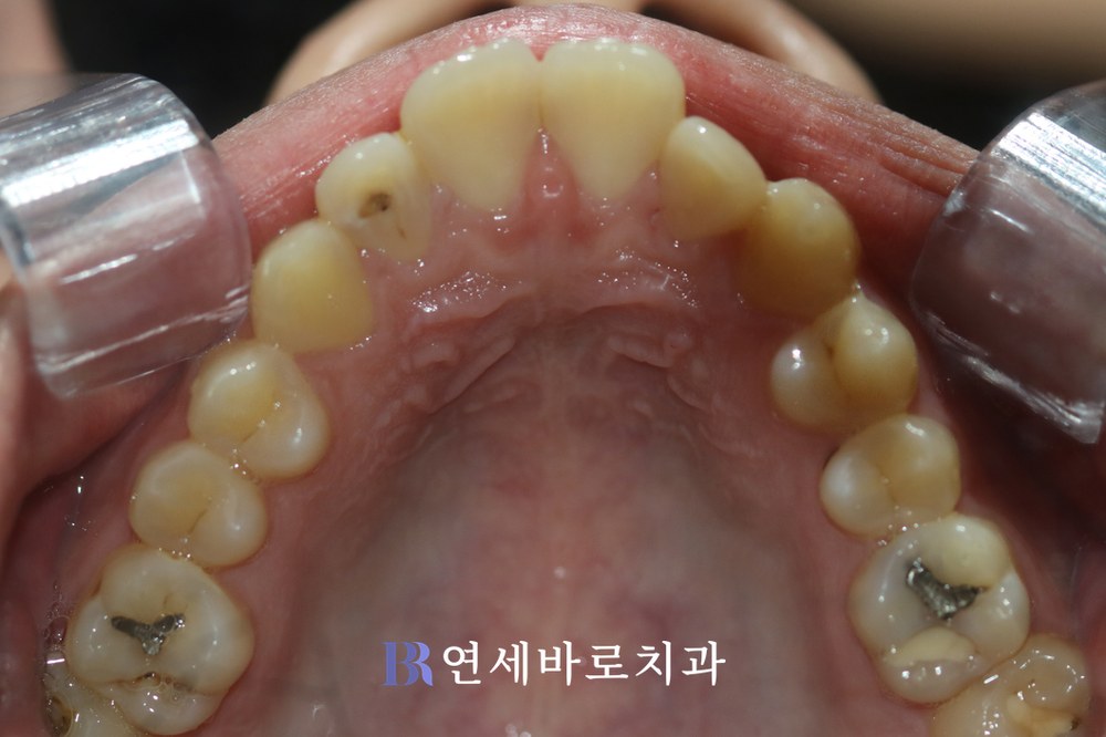 치료 전 ⑥
