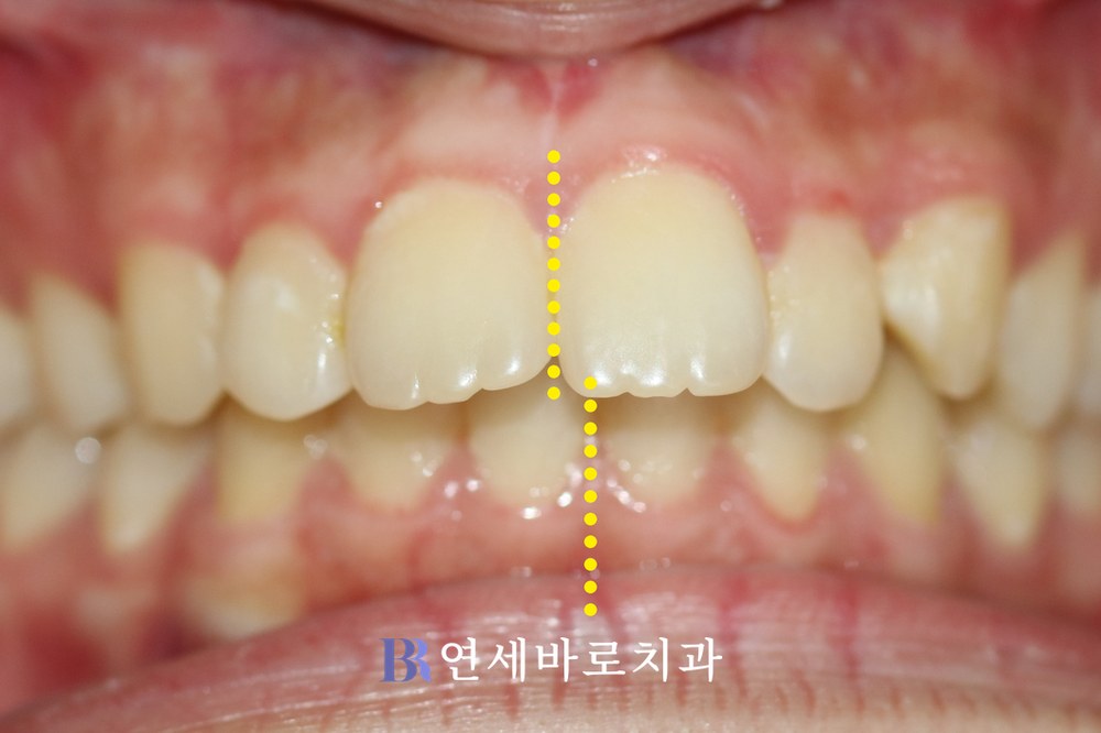 돌출입 치료 전 정면 구내 사진
