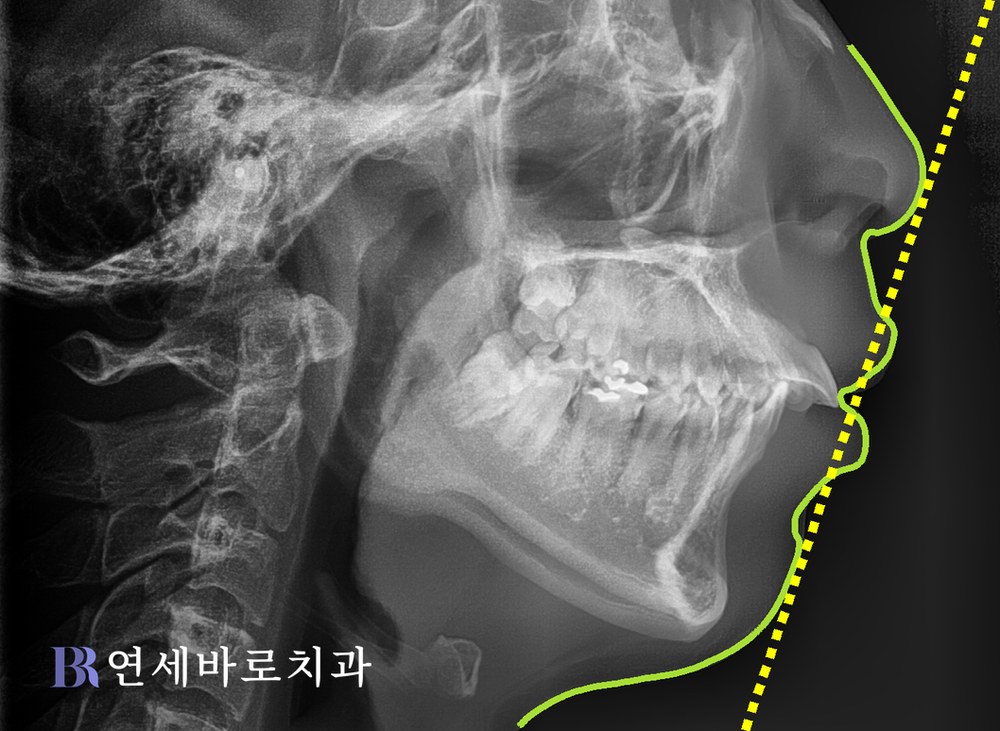 대전 치아교정 전문 치과 돌출입 치료 전 측면 엑스레이