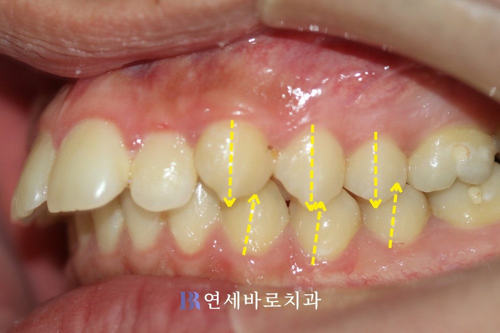 돌출입 치료 전 좌측 어금니 교합 사진