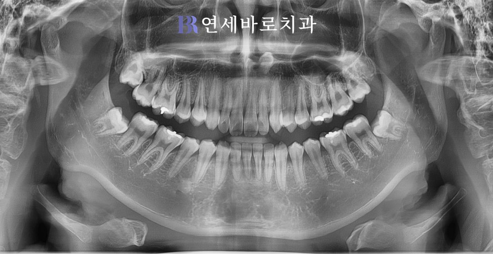 치료 전 ⑧