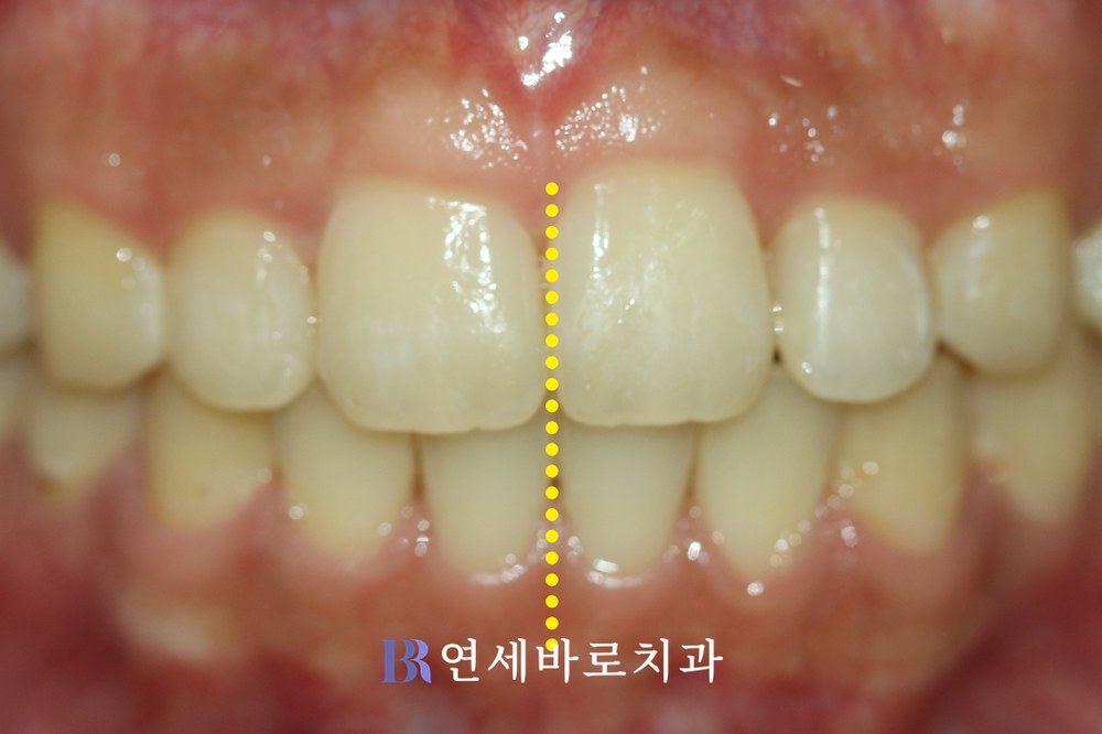 돌출입 치료 후 정면 구내 사진
