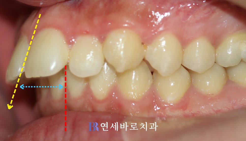 돌출입 치료 전 좌측 교합 사진