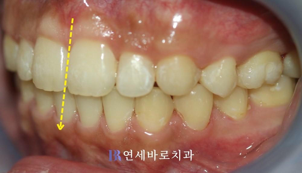 대전 치아교정 전문 치과 돌출입 치료 후 좌측 교합 사진