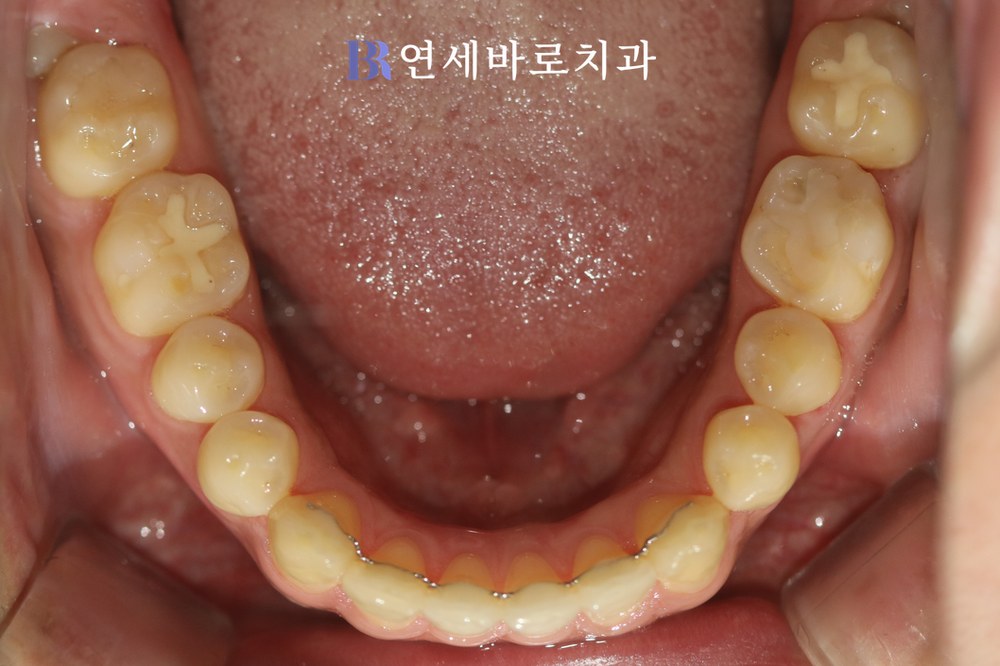 치료 후 ⑦