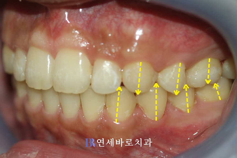 치료 후 ⑤
