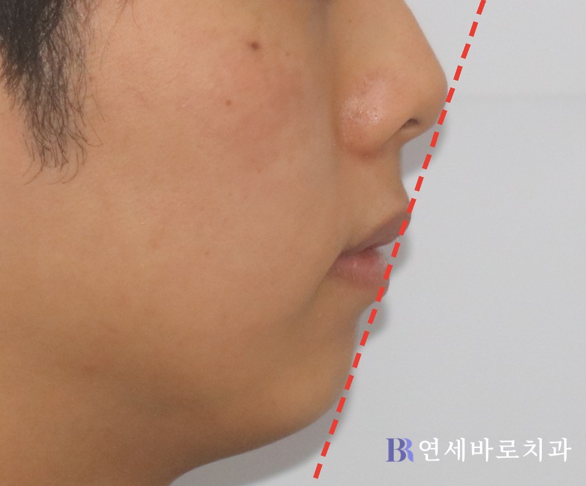 치료 후 ①
