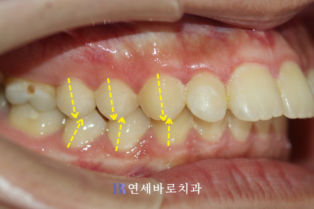 돌출입 치료 전 우측 교합 사진