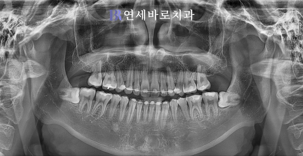 치료 후 ⑧