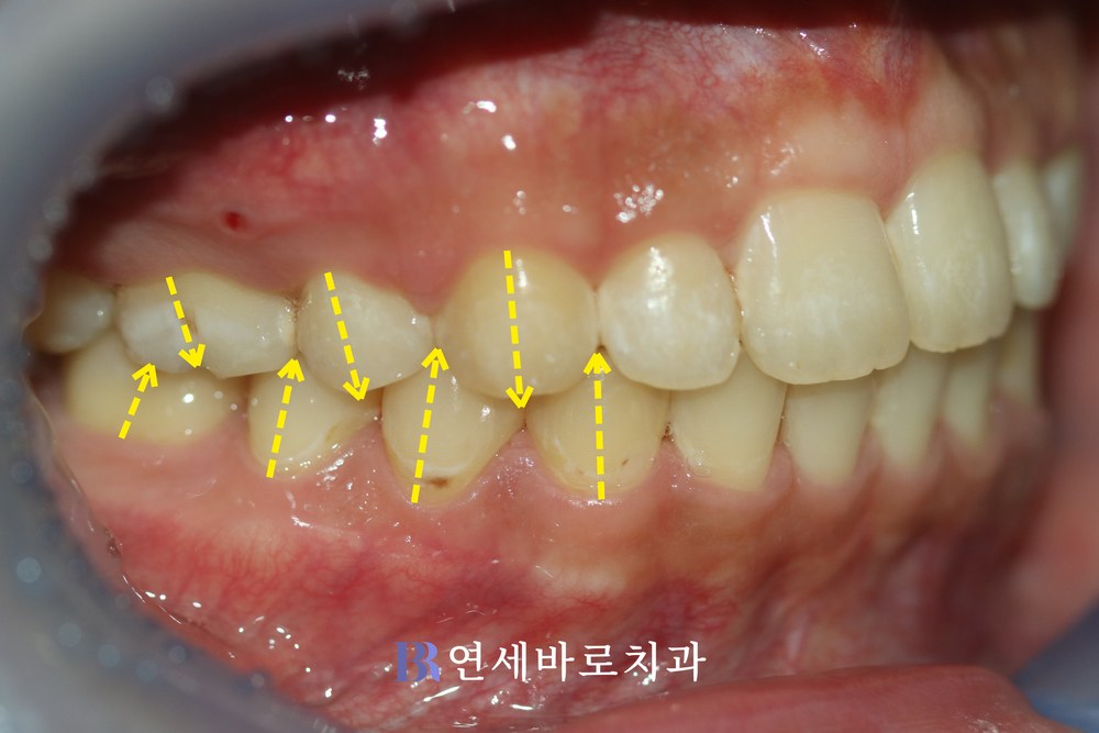 돌출입 치료 후 우측 교합 사진