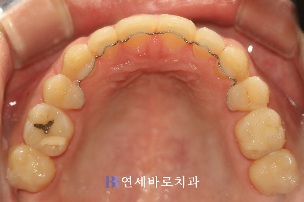 치료 후 ⑥