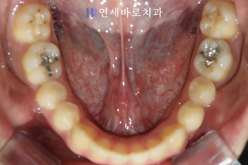치료 전 ⑦