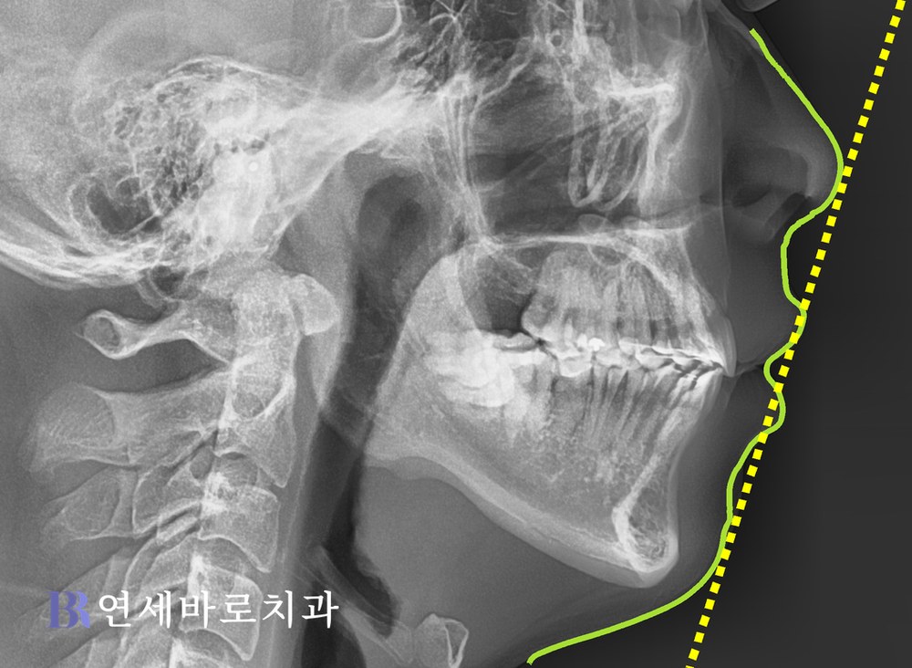대전 치아교정 전문 치과 돌출입 치료 후 측면 엑스레이