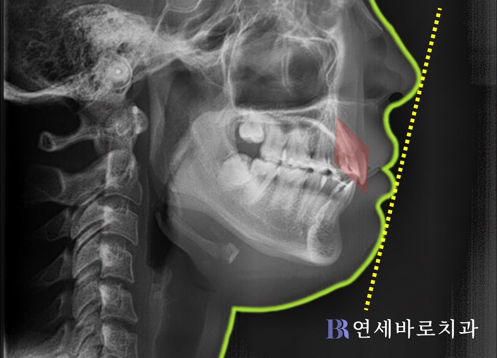 치간이개 치료 후 측면 엑스레이