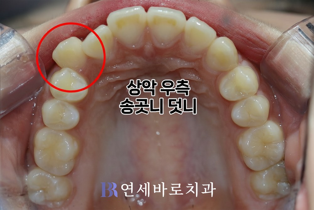 덧니 치료 전 상악 교합면 사진