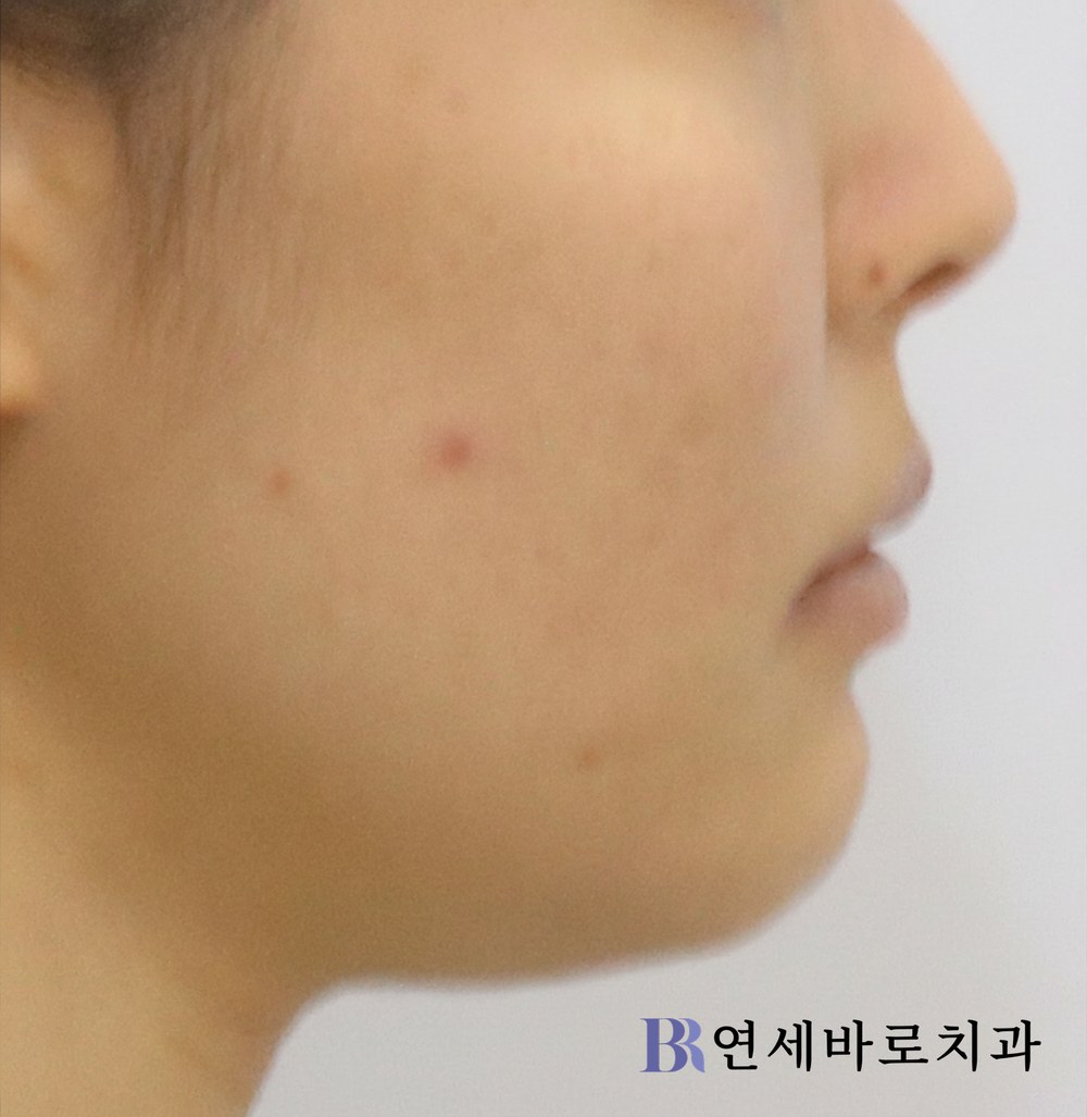 치료 후 ④
