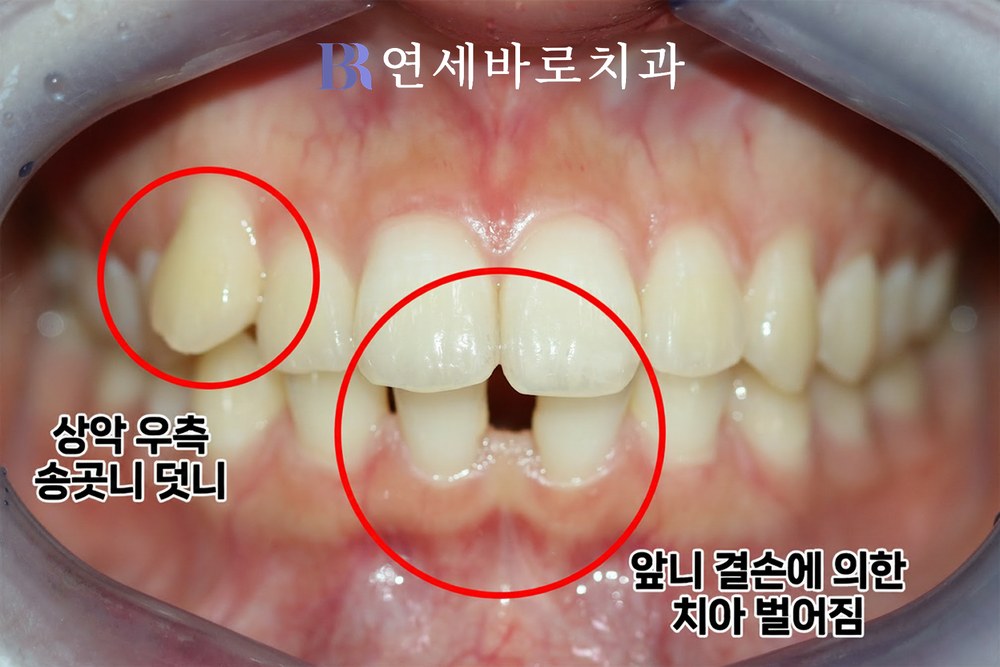 대전 가수원동 치과 벌어진 치아 치료 전 정면 구내 사진