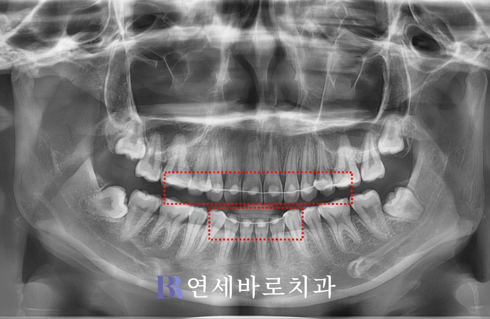 치료 후 ③