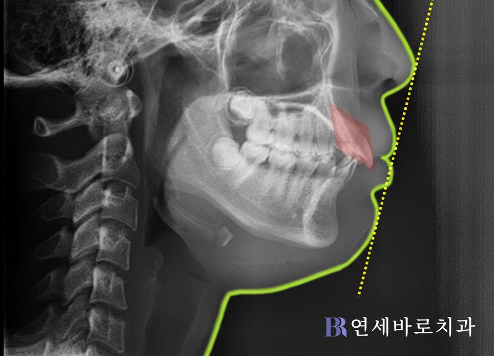 치료 전 측면 엑스레이 경미한 돌출입