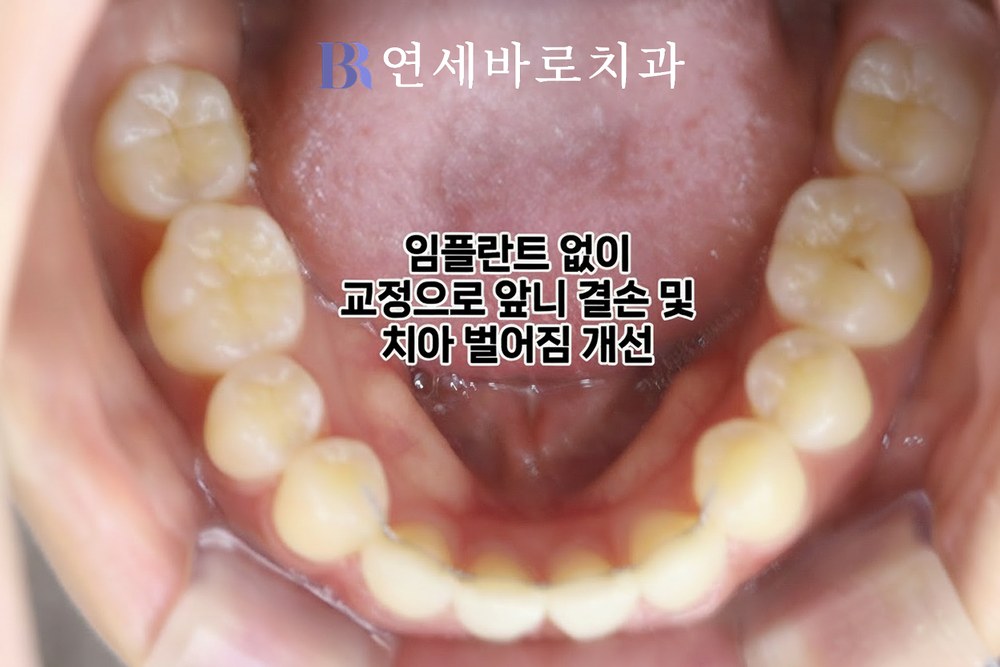벌어진 치아 치료 후 하악 교합면 사진
