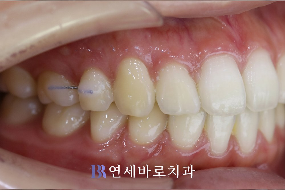 치료 후 ①
