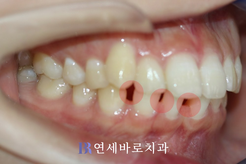 치료 전 ①