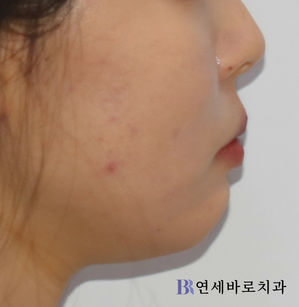 치료 전 ④