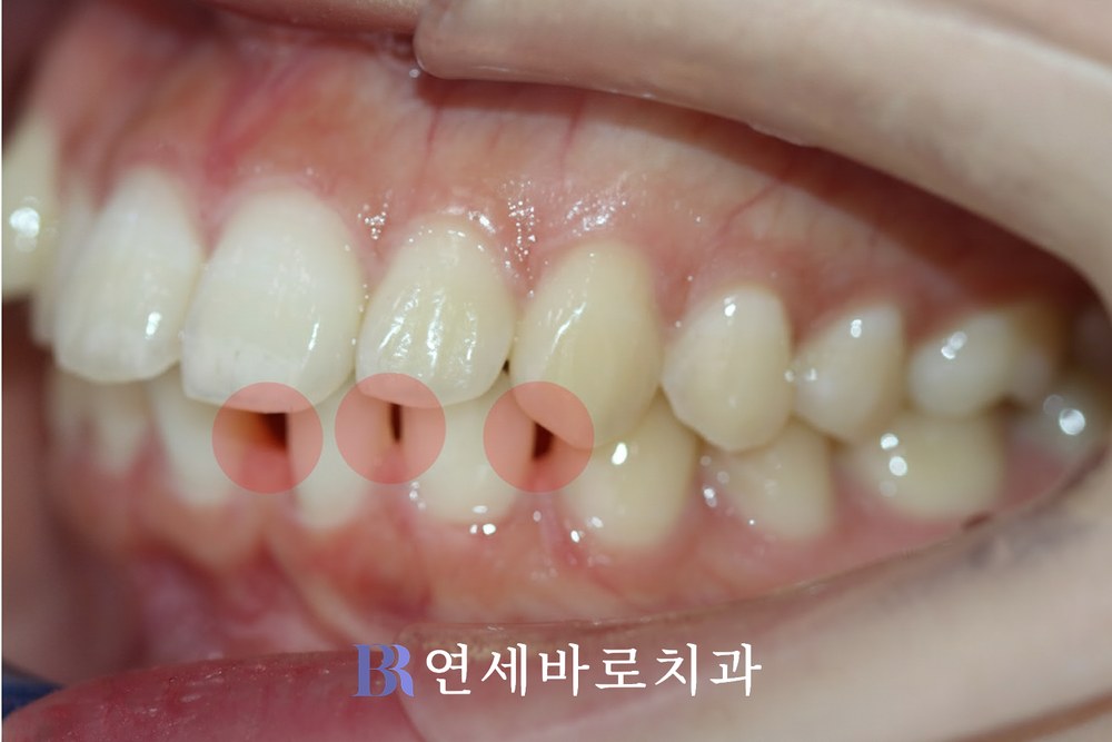 치료 전 ②