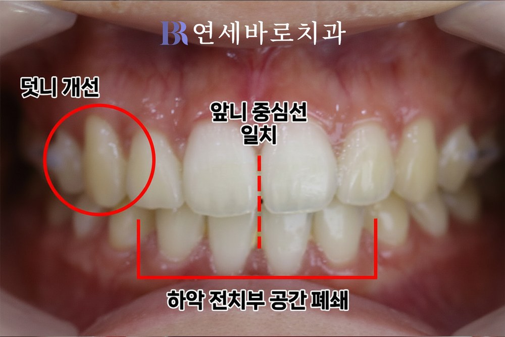 치간이개 치료 후 정면 구내 사진