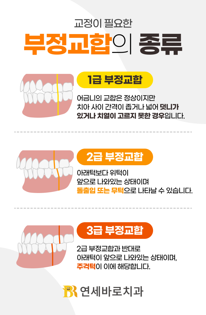 부정교합의 종류 1급 2급 3급 어금니 교합