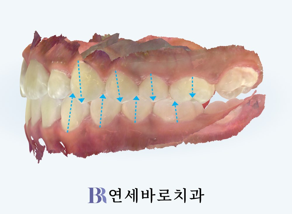 투명교정 치료 후 좌측 어금니 교합 사진