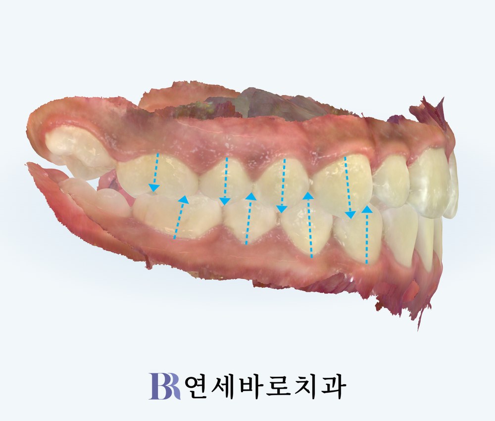 투명교정 치료 후 우측 어금니 교합 사진