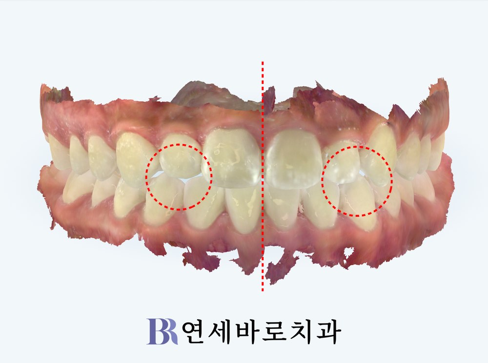인비절라인 퍼스트 치료 후 정면 구강 스캔 사진