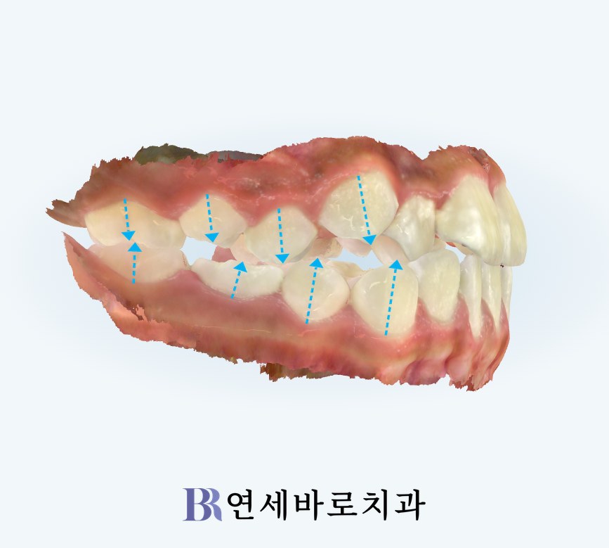 인비절라인 퍼스트 치료 전 우측 어금니 교합 사진