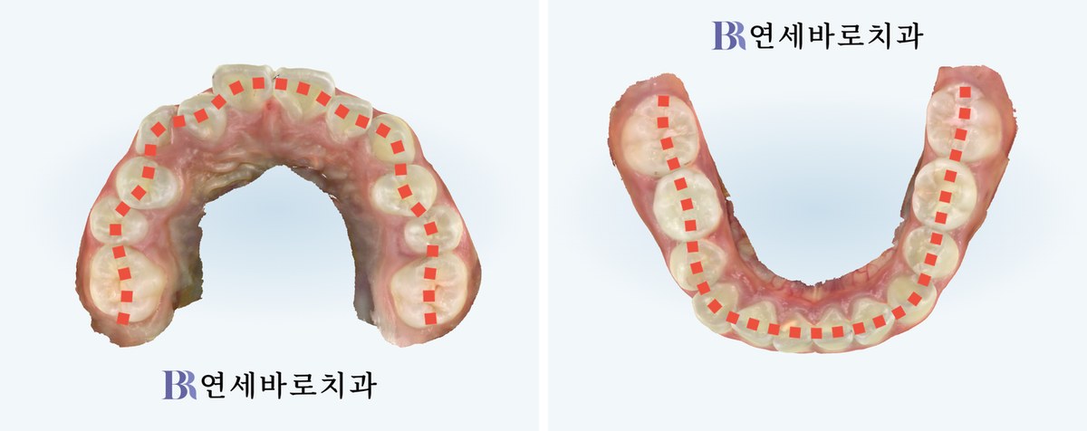 어린이 투명교정 치료 전 상악 하악 교합면 사진
