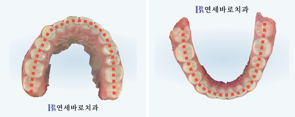 어린이 투명교정 치료 후 상악 하악 교합면 사진