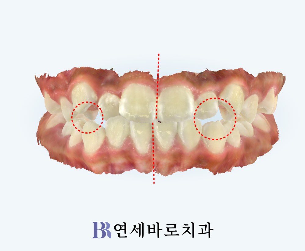 대전 월평동 치과 인비절라인 퍼스트 치료 전 정면 구강 스캔 사진