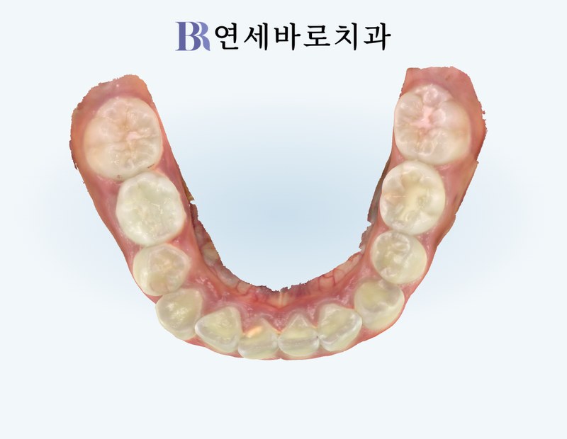 치료 전 하악