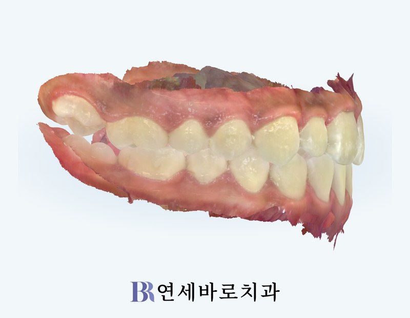 치료 후 우측