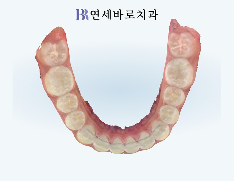 치료 후 하악