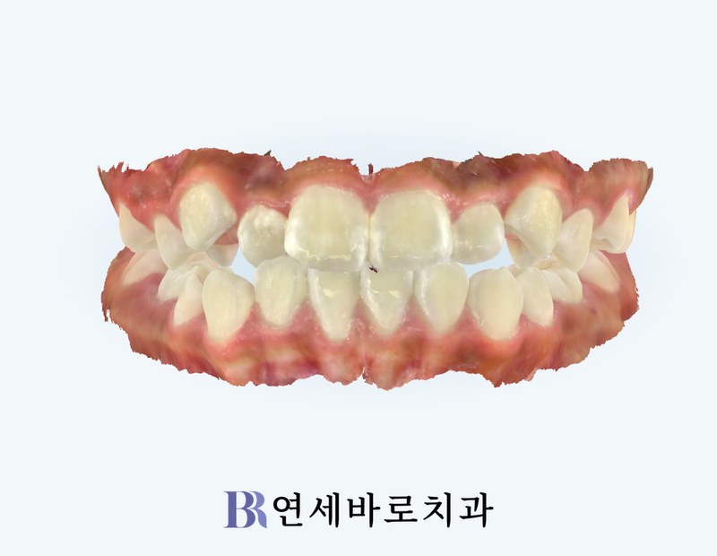 치료 전 정면