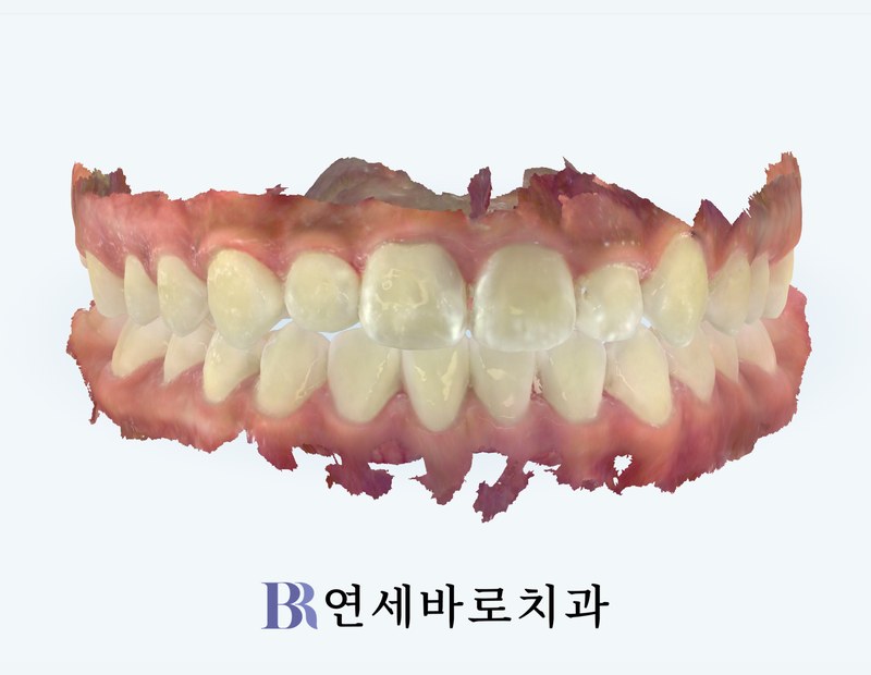 치료 후 정면